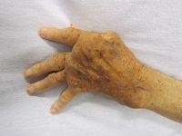 Rheumatoid arthritis Wiki, Facts